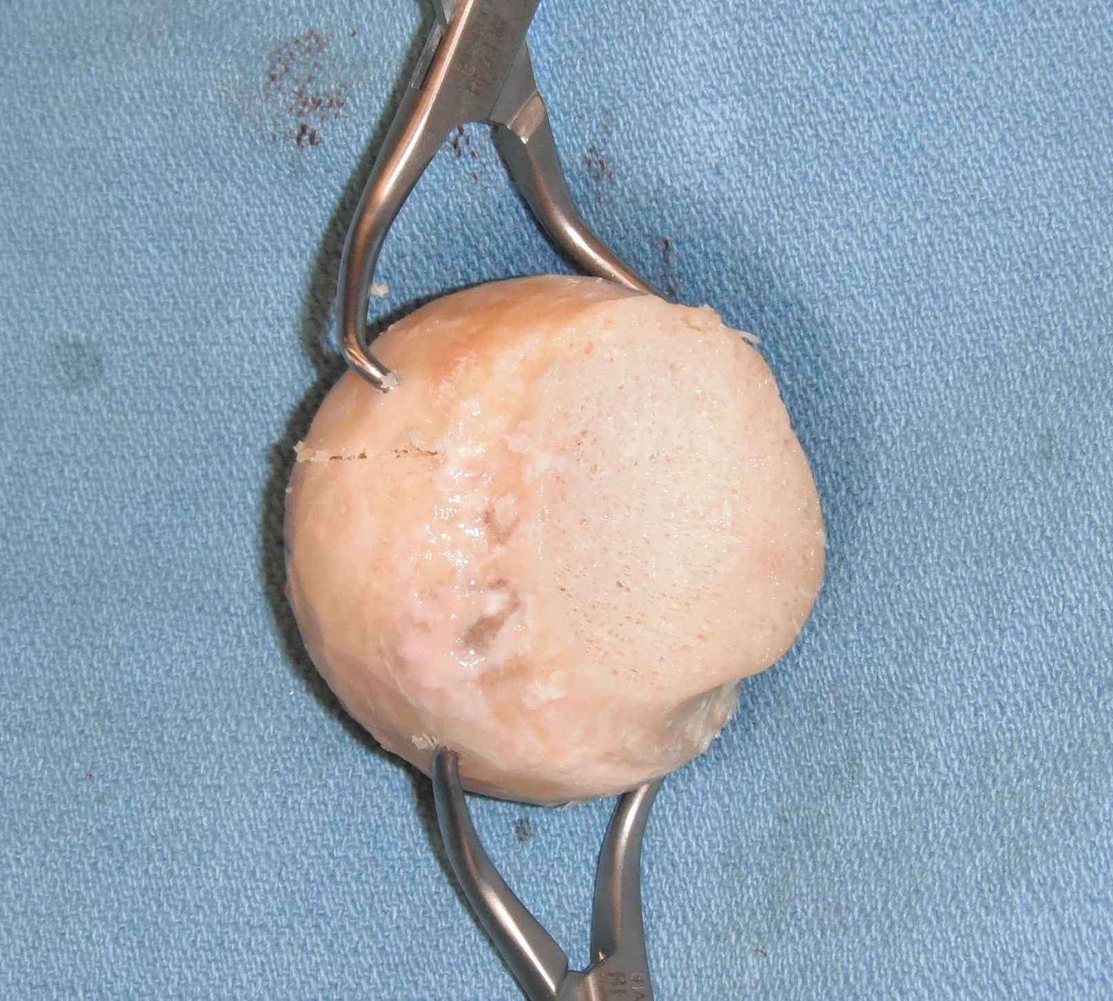 Femoral Head Allograft 2